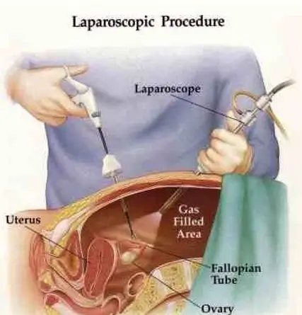 Laparoscopy in Fertility Treatment